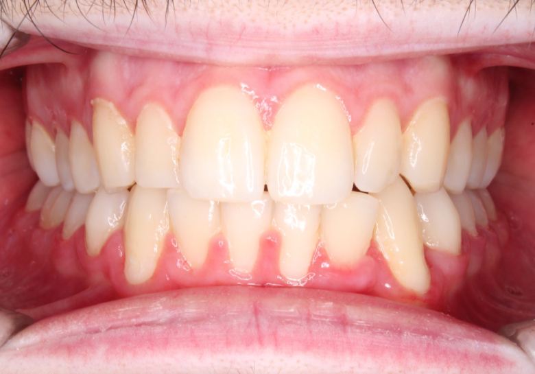 ortodonzia-dopo